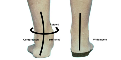 Insoles For Overpronation