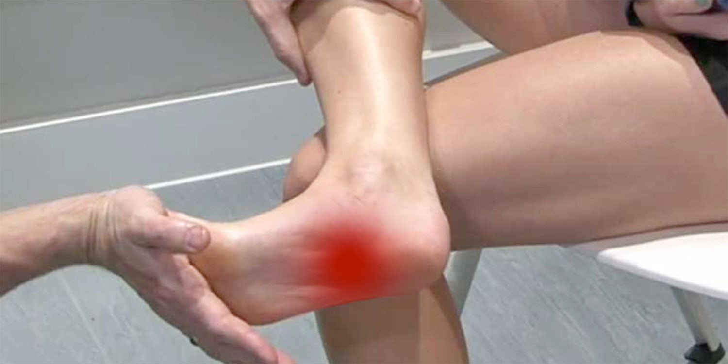 How Arch Support Helps Cure Plantar Fasciitis