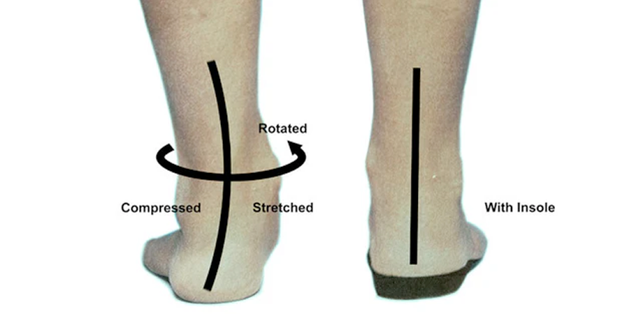 Insoles For Overpronation